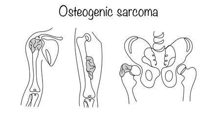Osteogenic sarcoma