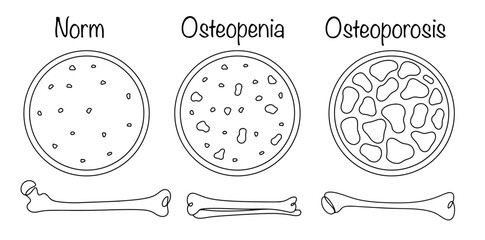 Osteopenia. Osteoporosis