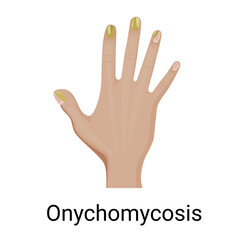 Fototapeta premium Onychomycosis on the fingernail vector illustration design.