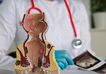 Doctor with model of human anatomy of rectum and hemorrhoids in hospital and ultrasound inflamed...