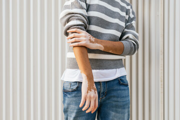 Mixed Race Person with Vitiligo Enjoys a Relaxed University Day