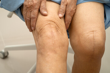 Asian elderly woman patient with scar knee replacement surgery in hospital.