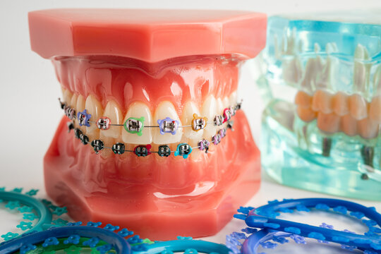 Orthodontic ligatures rings and ties, elastic rubber bands on orthodontic braces, model for dentist studying about dentistry.