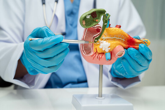 Pancreatitis, pancreatic cancer, Asian doctor with pancreas, gallbladder and bile duct human anatomy model at hospital.