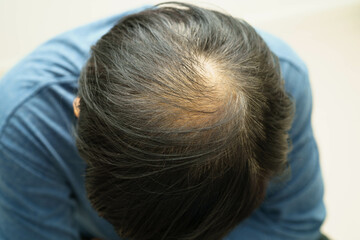 Bald head in man, hair loss treatment health problem.