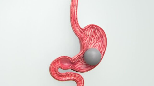 Gastric Balloon UHD Video | Silicone balloon in the stomach video | Intragastric balloon therapy video in UHD