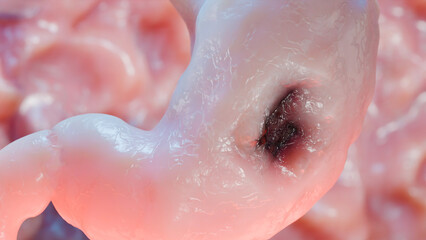 Fototapeta premium Stomach cancer. stages tumor growth in digestive system, Peptic Ulcer anatomy, Cancer attacking cell. gastric disease concept. symptoms, malignant cancerous, viruses and bacteria, 3d render