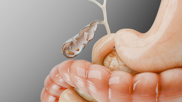 Gallstones in the gallbladderand bile duct, human silhouette and anatomy of surrounding organs, liver and gallbladder with stones, Realistic 3D Render