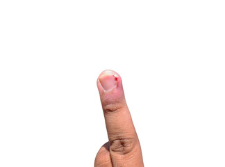 middle finger injured by an ingrown toenail