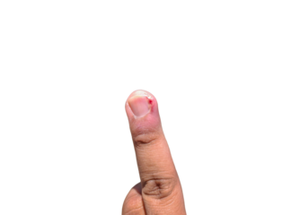 middle finger injured by an ingrown toenail