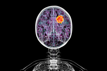 Brain tumor, 3D illustration