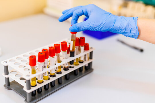 Tech processing blood samples in clinic. A laboratory technician wearing a blue glove sorts blood samples in a clinic, ensuring proper handling and storage.