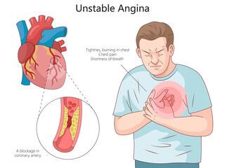 symptoms of unstable angina and blockage in coronary arteries causing chest pain and shortness of breath diagram hand drawn schematic raster illustration. Medical science educational illustration - obrazy, fototapety, plakaty