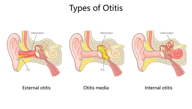 otitis ear infections external otitis, otitis media, and internal otitis with inflammation and pus buildup diagram hand drawn schematic raster illustration. Medical science educational illustration