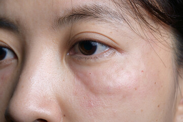 Close up of woman face with under eye swelling