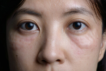 Close up of woman face with under eye swelling