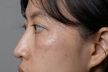 Side profile of woman with facial skin swelling and redness