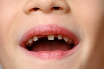 Child opens his mouth to show loose baby tooth and an erupting front permanent tooth next to it,...