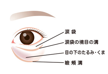 Obraz premium 目の下のたるみ たるんだ下まぶた