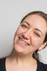 Closeup Ceramic and Metal Brackets on the Teeth