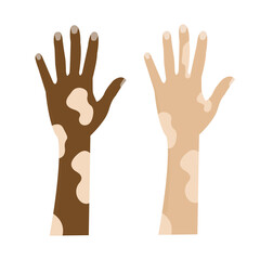 vector hands whose skin is white and striped due to vitiligo disease