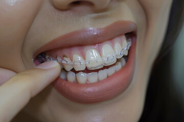 A woman is smiling and holding a clear plastic retainer in her mouth. The retainer is white and he is a clear plastic tray.