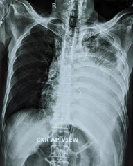 Chest xray showing left sided massive pleural effusion 