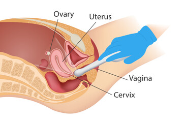 Transvaginal ultrasound scanner of the internal pelvic organs. The concept of women's health