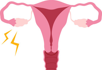 Ovarian disease illustration. 