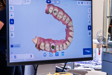 3D jaw on the monitor of a dentist scanner.