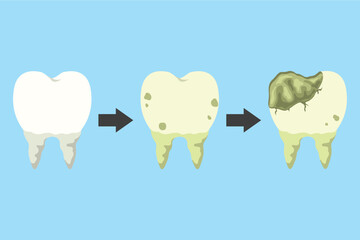 concept illustration of stages of tooth decay, flat style vector illustration.
