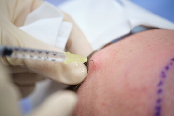 Hair transplant procedure close-up with injection and scalp