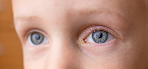 A little baby with soured eyes suffers from conjunctivitis