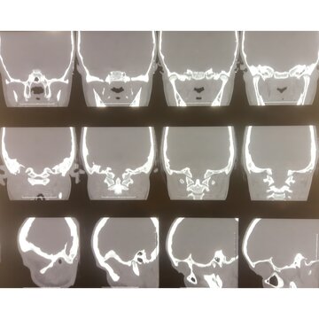 CT scan of the temporal bones showing soft tissue density lesion at bilateral middle ear and mastoid aircells. Inflammatory granulation tissue.