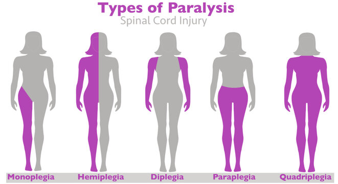 Palsy, spinal cord injury, paralysis types. Monoplegia, paraplegia, hemiplegia, diplegia, quadriplegia. causes, stroke, tumor, nerve damage brain injuries. Side woman, human body. Vector illsustration