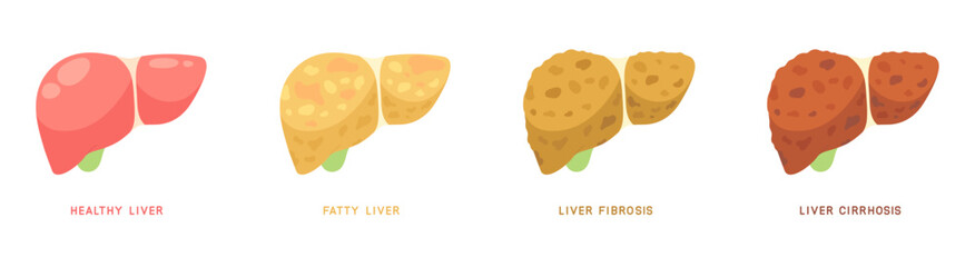 Stages of damaged liver. Healthy, fatty liver, fibrosis, cirrhosis to liver cancer. Concept of Medical infographic, liver diseases, NAFLD, NASH, health care, internal organ. Flat vector illustration.