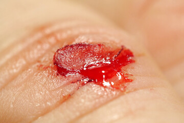 Injury of middle finger of right hand with bleeding. Flayed skin,blood and lymph