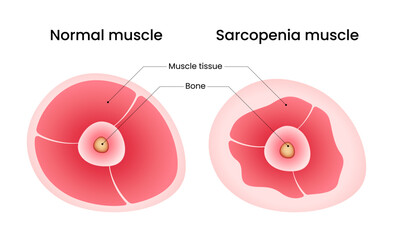 Normal muscle and Sarcopenia muscle