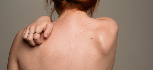 Woman scratching her back. Rash irritation. Dermatology. Itchy, itch spot or rash of skin. Skin...