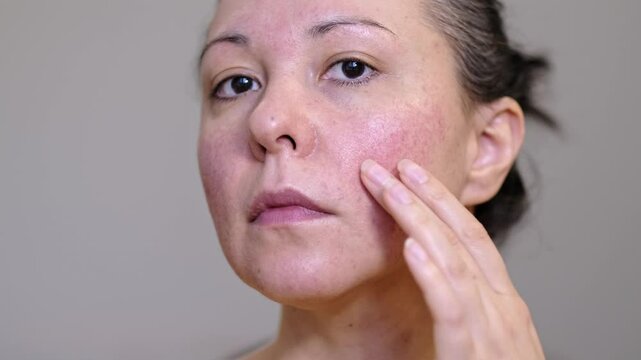 Detailed view of uneven skin with acne and pimples. Facial pores, blemishes, and natural texture. Concept of skin issues, treatments, and care for a healthy appearance.