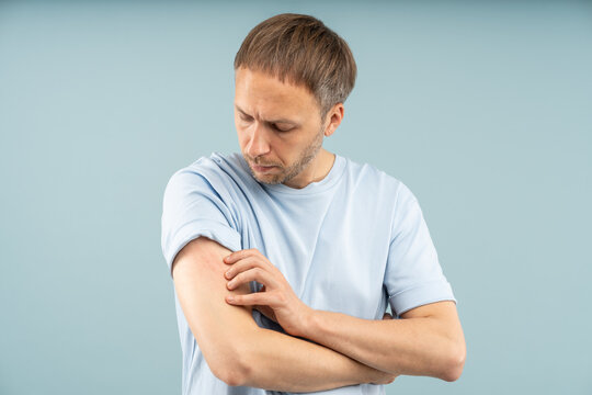 Frustrated man scratches arm with red streaks from itching suffering allergic reaction, food sensitivities, contact dermatitis, eczema or insect bites. Dermatological symptoms, discomfort inflammation