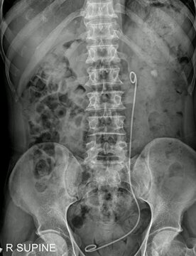 KUB X-ray Showing Kidney Stones 