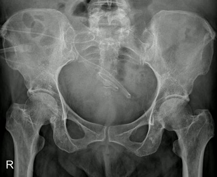 Female Pelvis X-ray AP View Detailing Pelvic Bones and Hip Joint