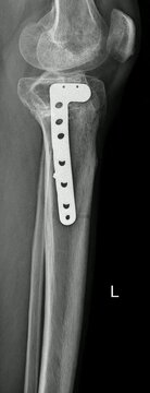 Tibial Plateau Fracture Fixation X-Ray Imaging