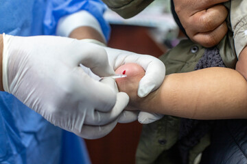 Tamizaje de hemoglobina para detectar anemia en bebés - Hemoglobin screening to detect anemia in babies