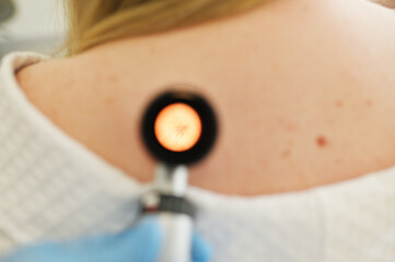 a dermatologist examines moles and skin growths on the patient's body using a special device - a...