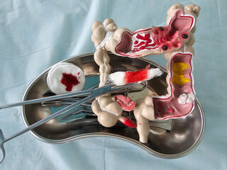 Surgical interventions on the intestines. Intestinal surgery. Colon resection and treatment concept