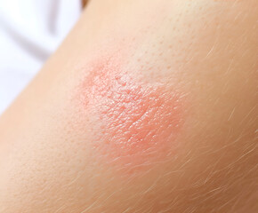 Fototapeta premium Localized Dermatitis on Skin