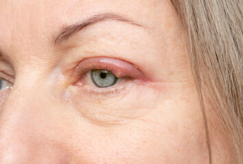 Inflammatory process on the upper eyelid. Purulent stye (chalazion) on the eye of a woman..