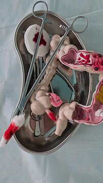 Surgical interventions on the intestines. Intestinal surgery. Colon resection and treatment 